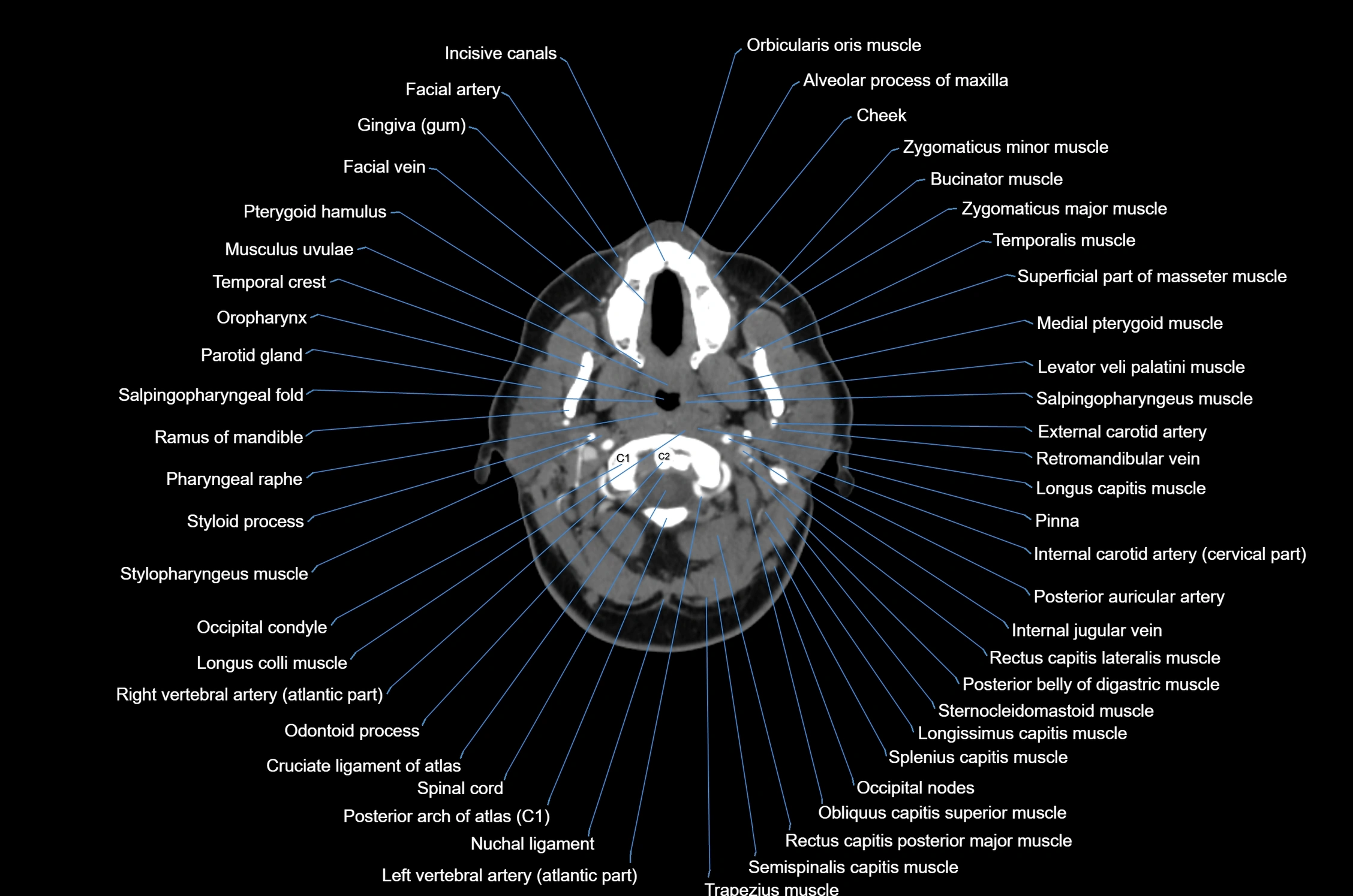 CT Neck axial cross sectional anatomy radiology image-img-00001-00022.webp